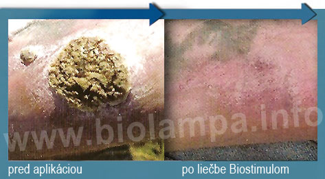 http://www.morcata.sk/biolampa/popalenina.jpg