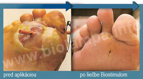 http://www.morcata.sk/biolampa/diabetickanoha2.jpg