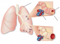 Astma biolampa Biostimul